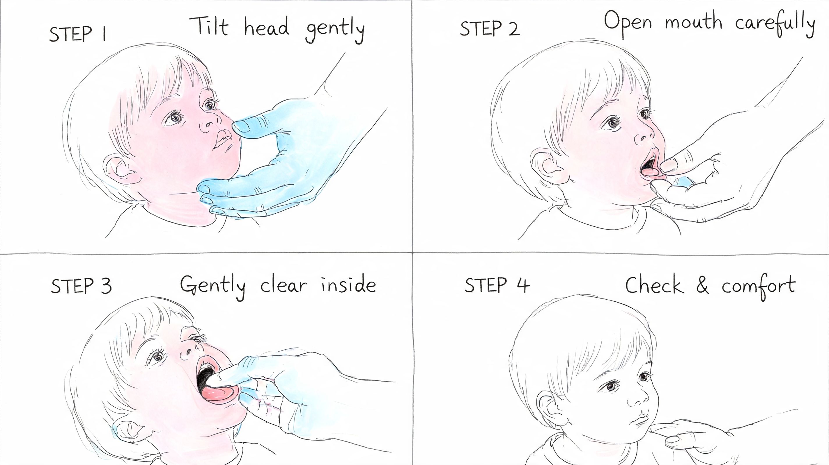 A four-step medical illustration showing a person clearing a young child's mouth for safety during an emergency.
