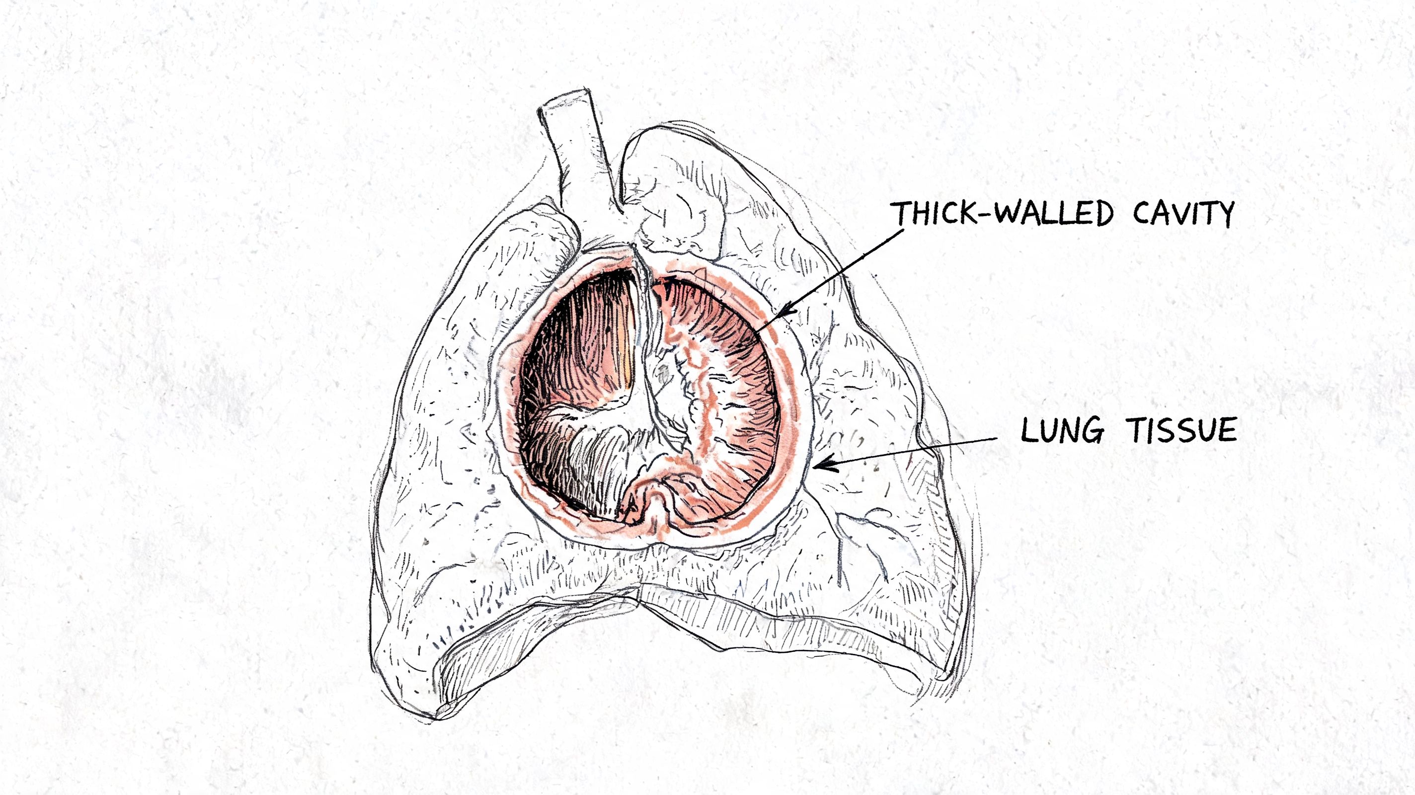 A medical illustration of a human lung cross-section showing a pathological thick-walled cavity lesion within lung tissue.