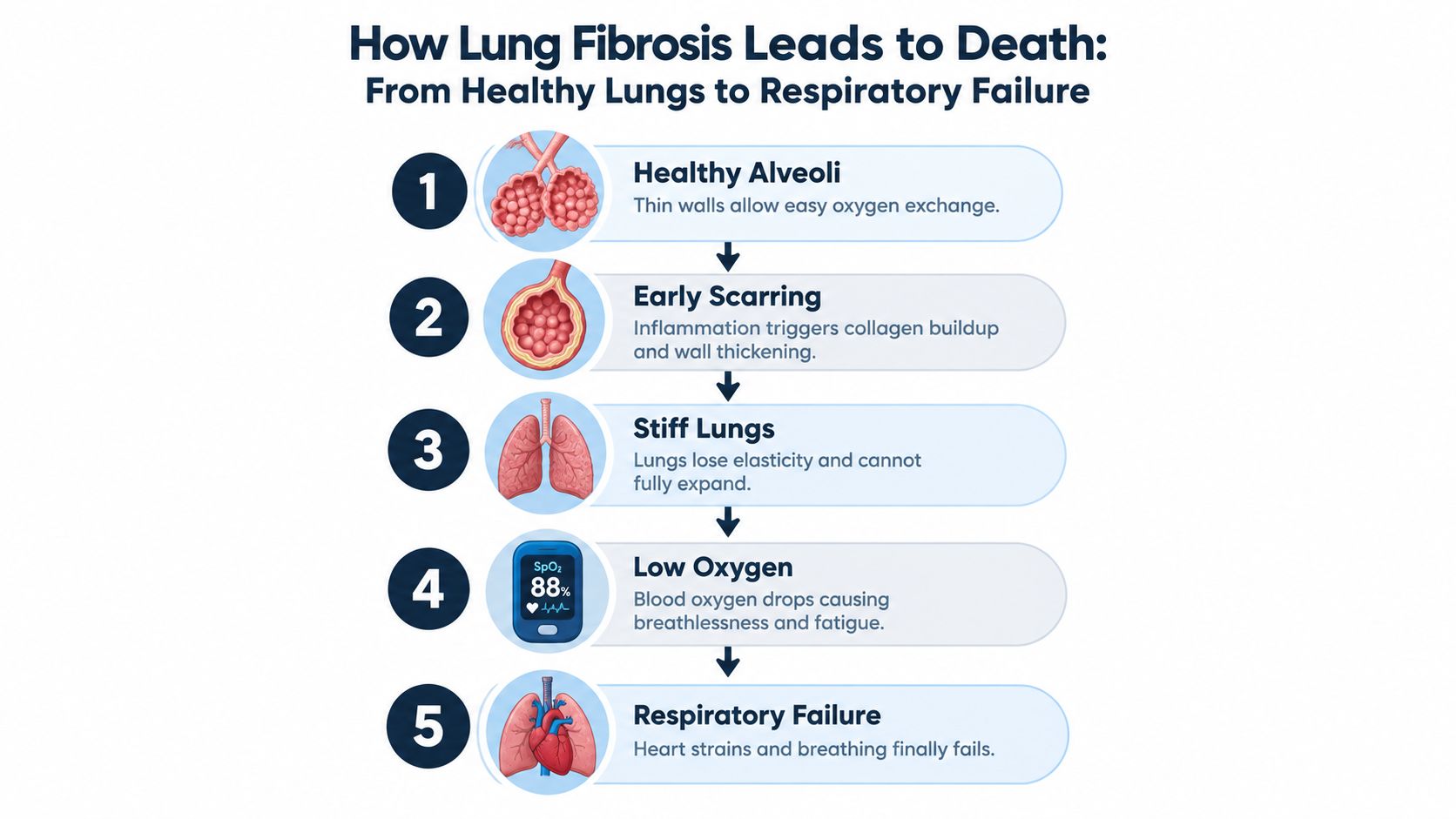 A five-step infographic illustrating the progression of lung fibrosis from healthy alveoli to respiratory failure.