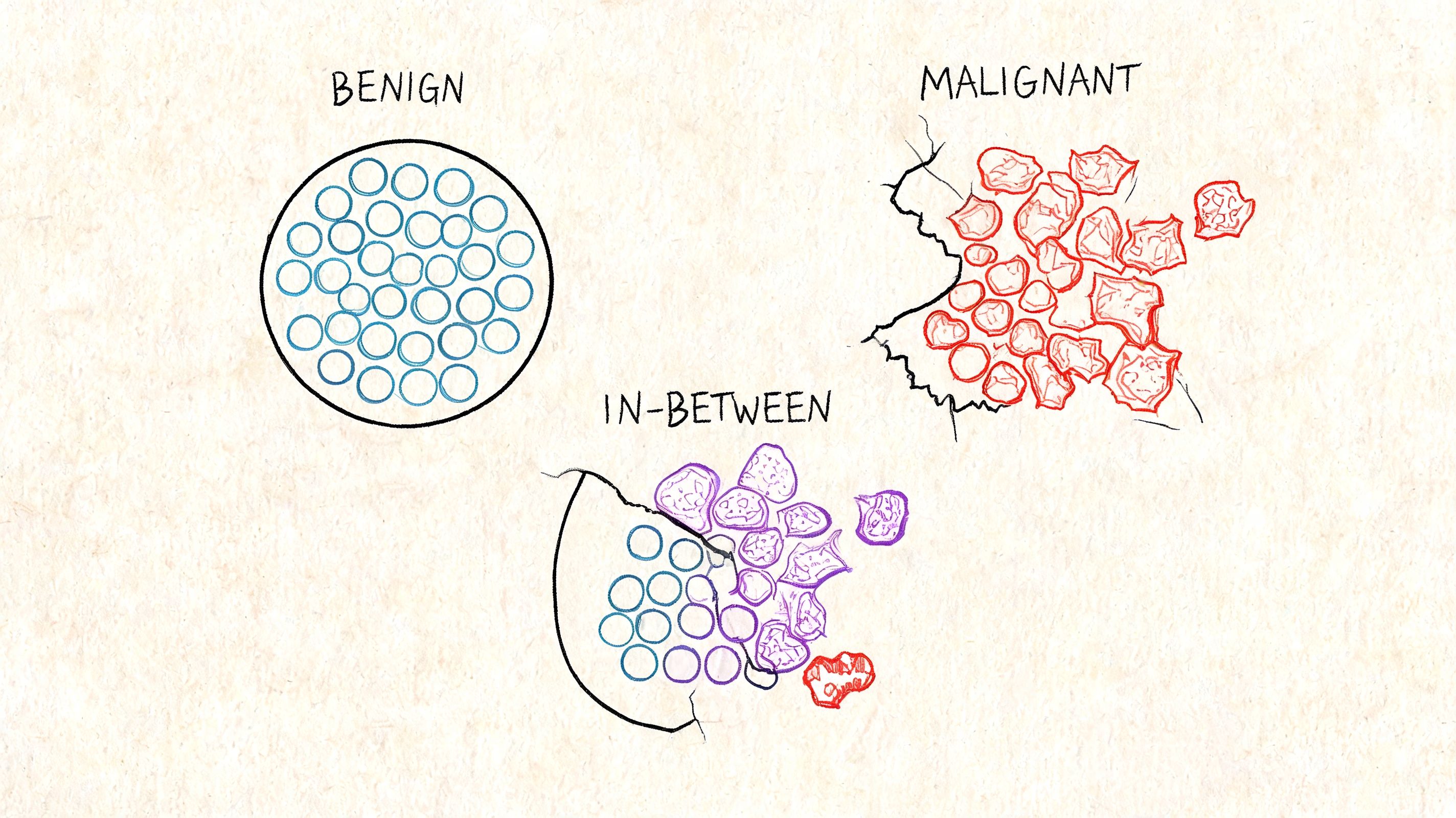 A diagram comparing the cellular appearance and structure of benign, in-between, and malignant skin lesion biopsy results.