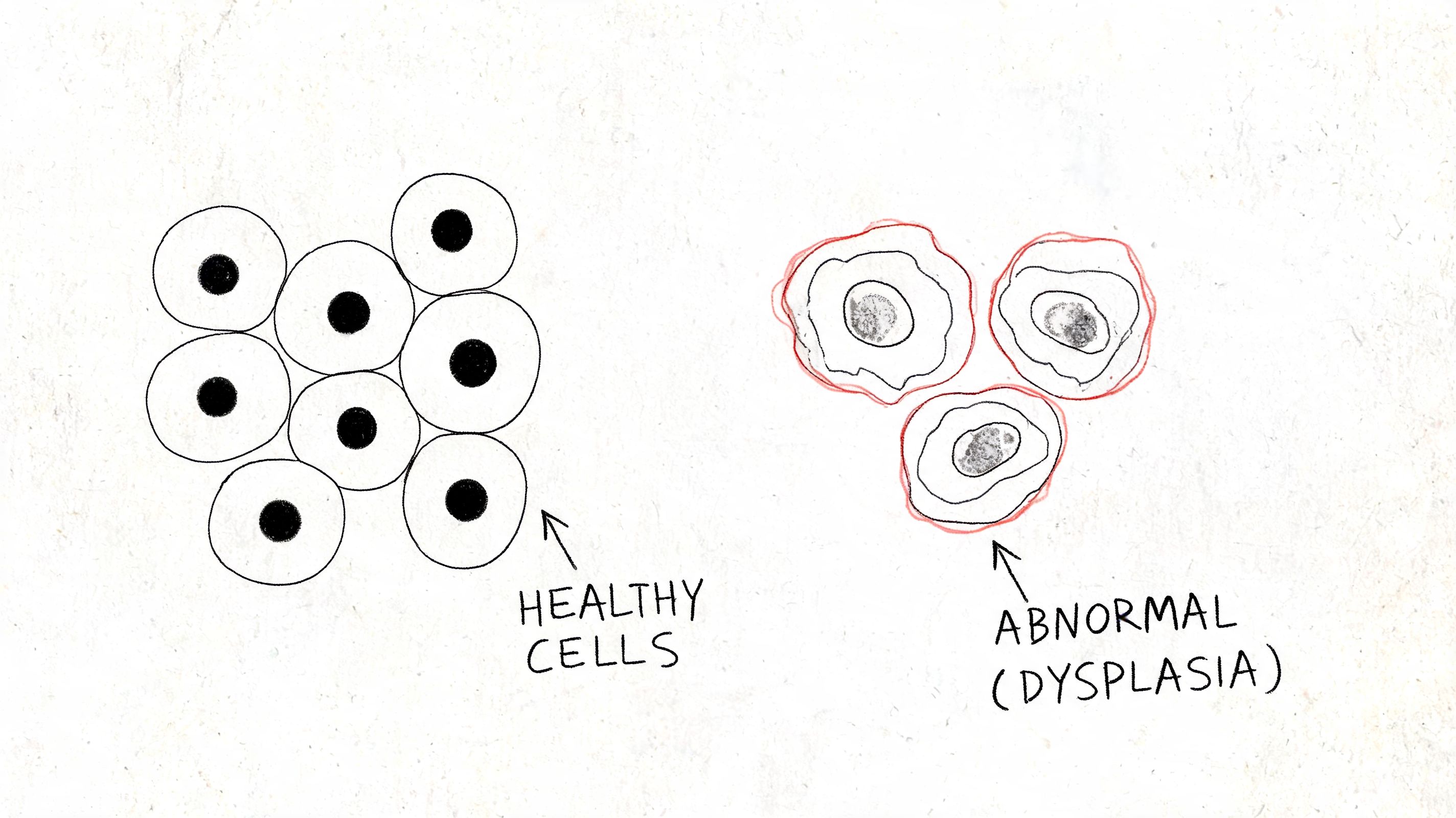 A diagram comparing normal healthy cells to abnormal cells showing signs of dysplasia in a medical context.